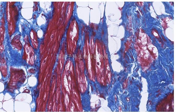 桥粒蛋白分解是心脏病的潜在机制